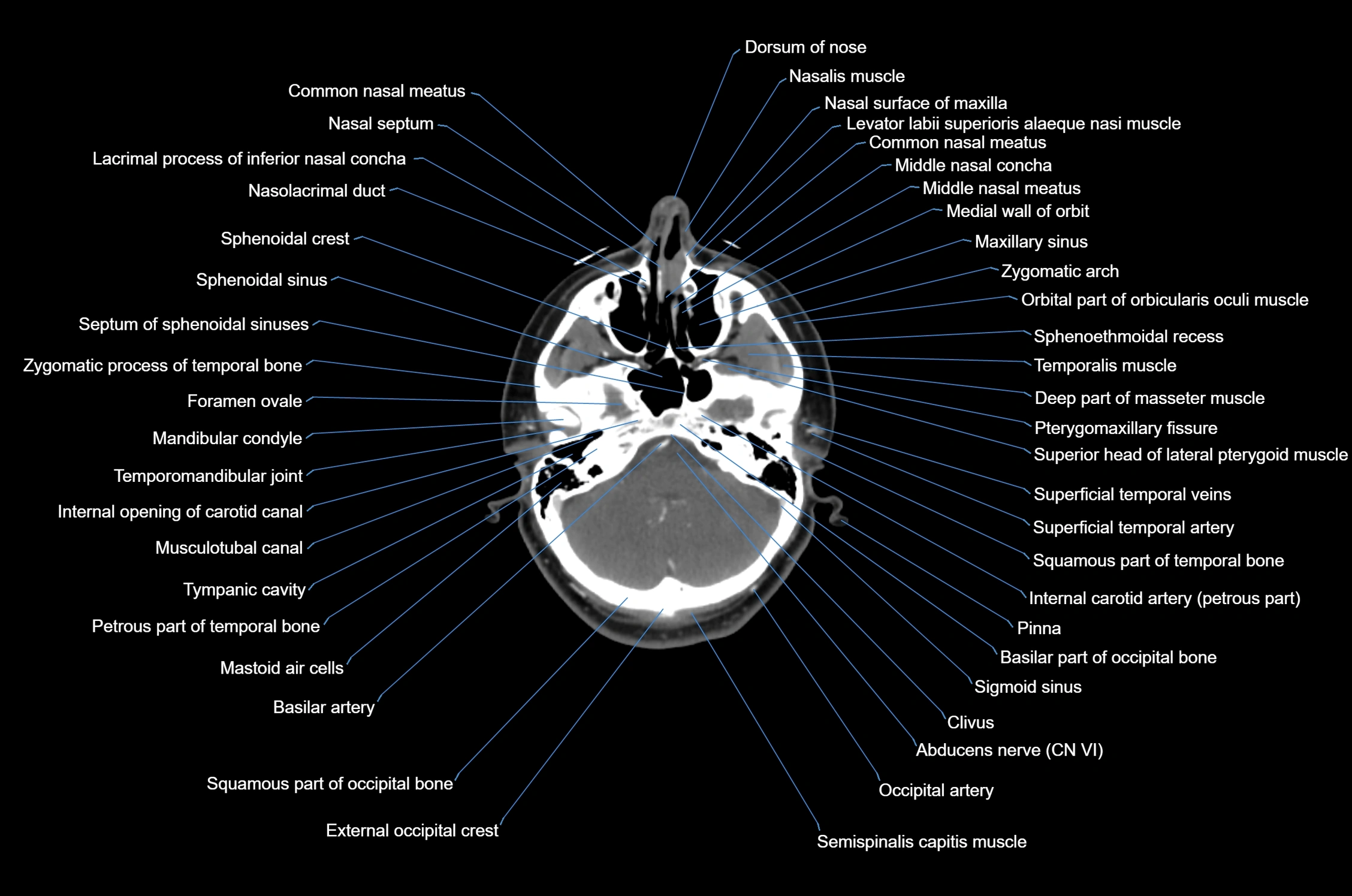 CT Neck axial cross sectional anatomy radiology image-img-00001-00013.webp